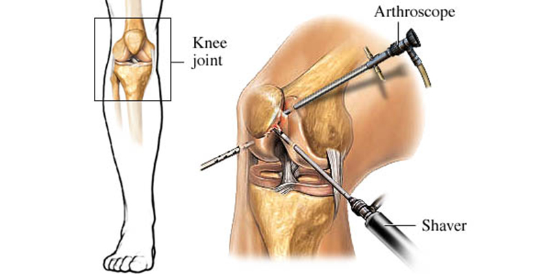 Knee Arthroscopy Surgery