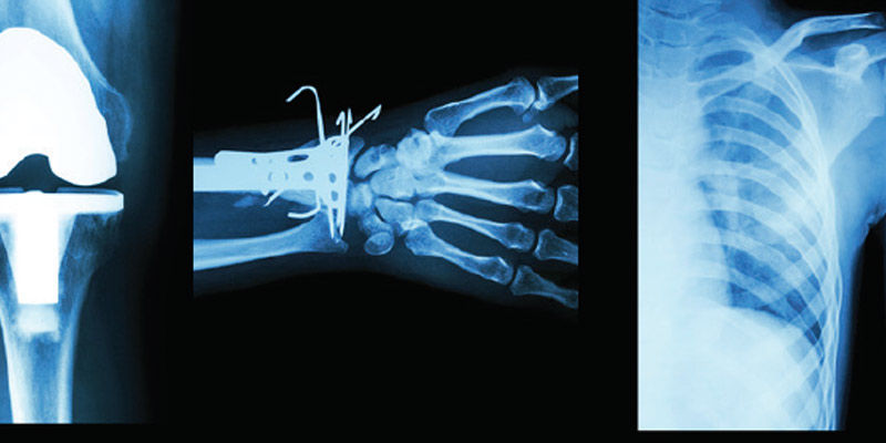 Fracture Surgery in Chennai